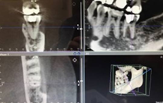 歯科用CT撮影 イメージ画像